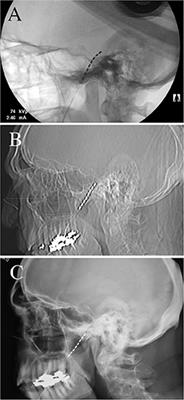 Case Report: Novel Anchoring Technique and Surgical Nuances for Trigeminal Ganglion Stimulation in the Treatment of Post-Herpetic Trigeminal Neuropathic Facial Pain